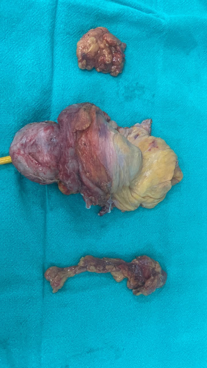 Robotic radical cystectomy for cancer of bladder