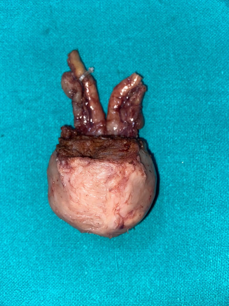 Innocent appearing cancer prostate - Robotic Radical prostatectomy
