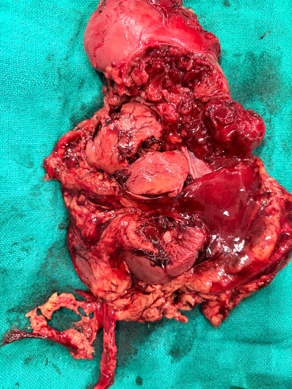 Completely shattered kidney after road traffic accident