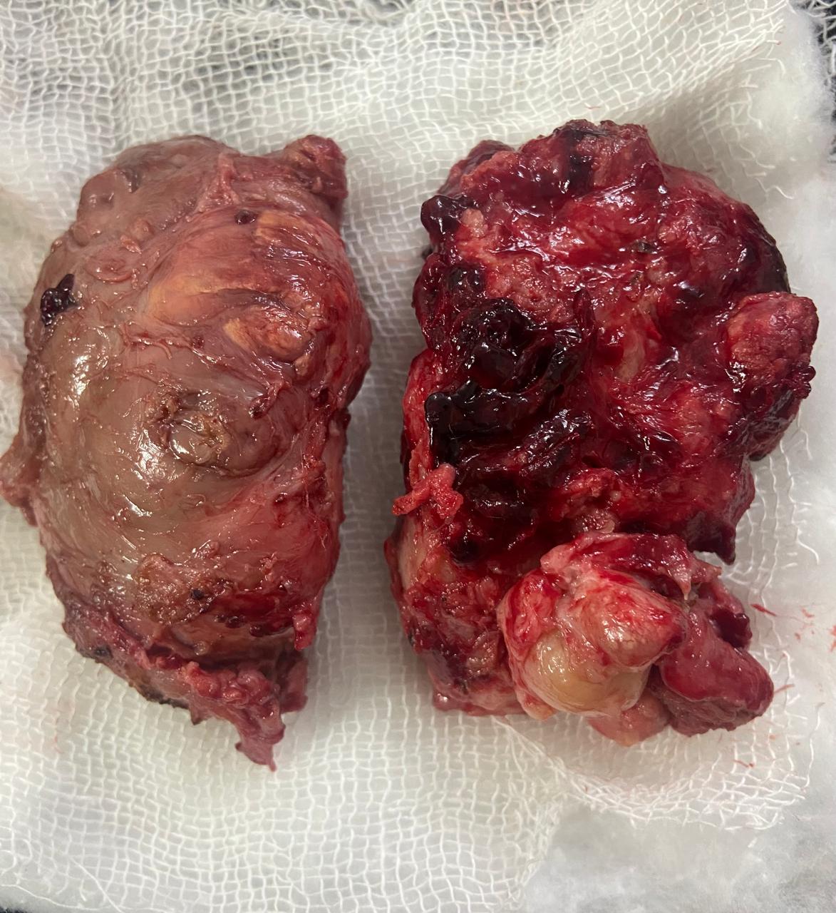 Robotic simple prostatectomy for large benign enlargement of prostate