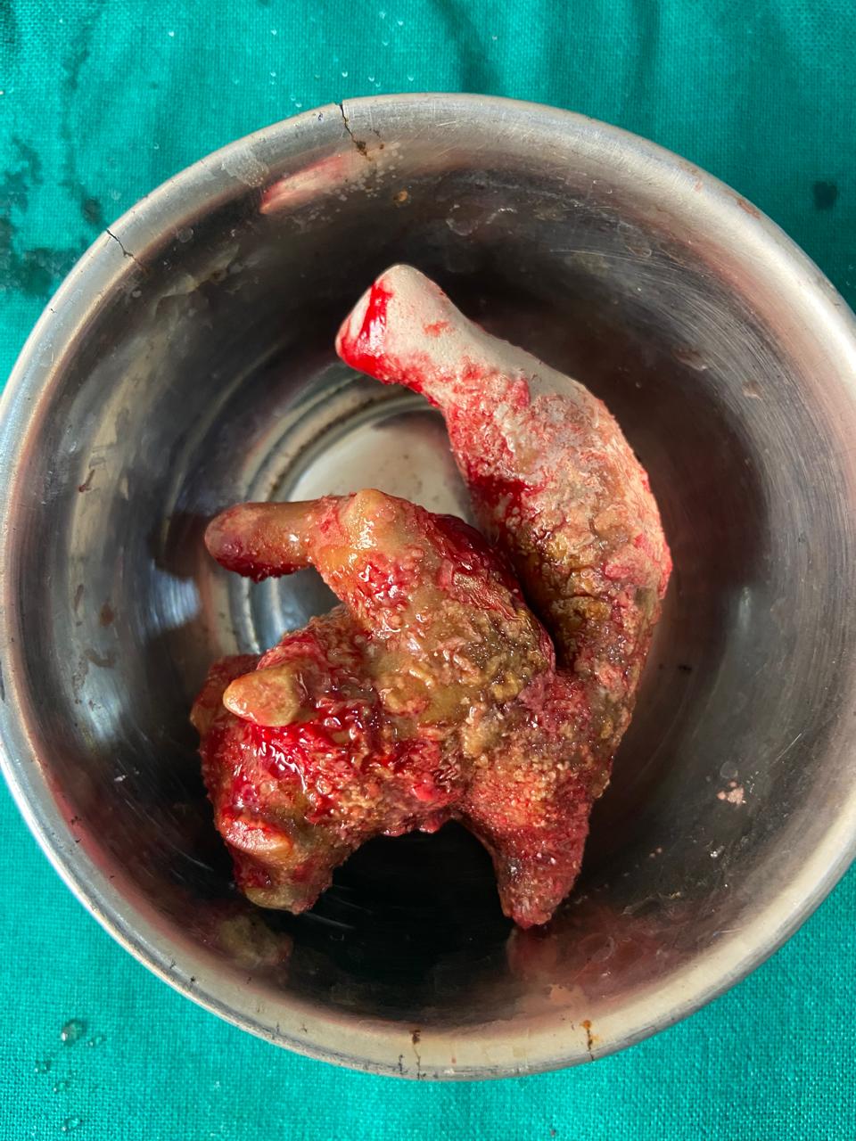 Robotic pyelolithotomy for large staghorn kidney stone