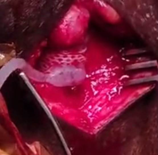 Artificial urinary sphincter for urinary incontinence