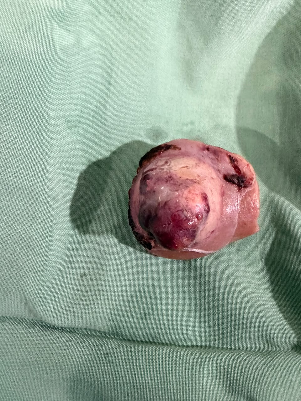 Specimen of robotic partial nephrectomy for kidney cancer