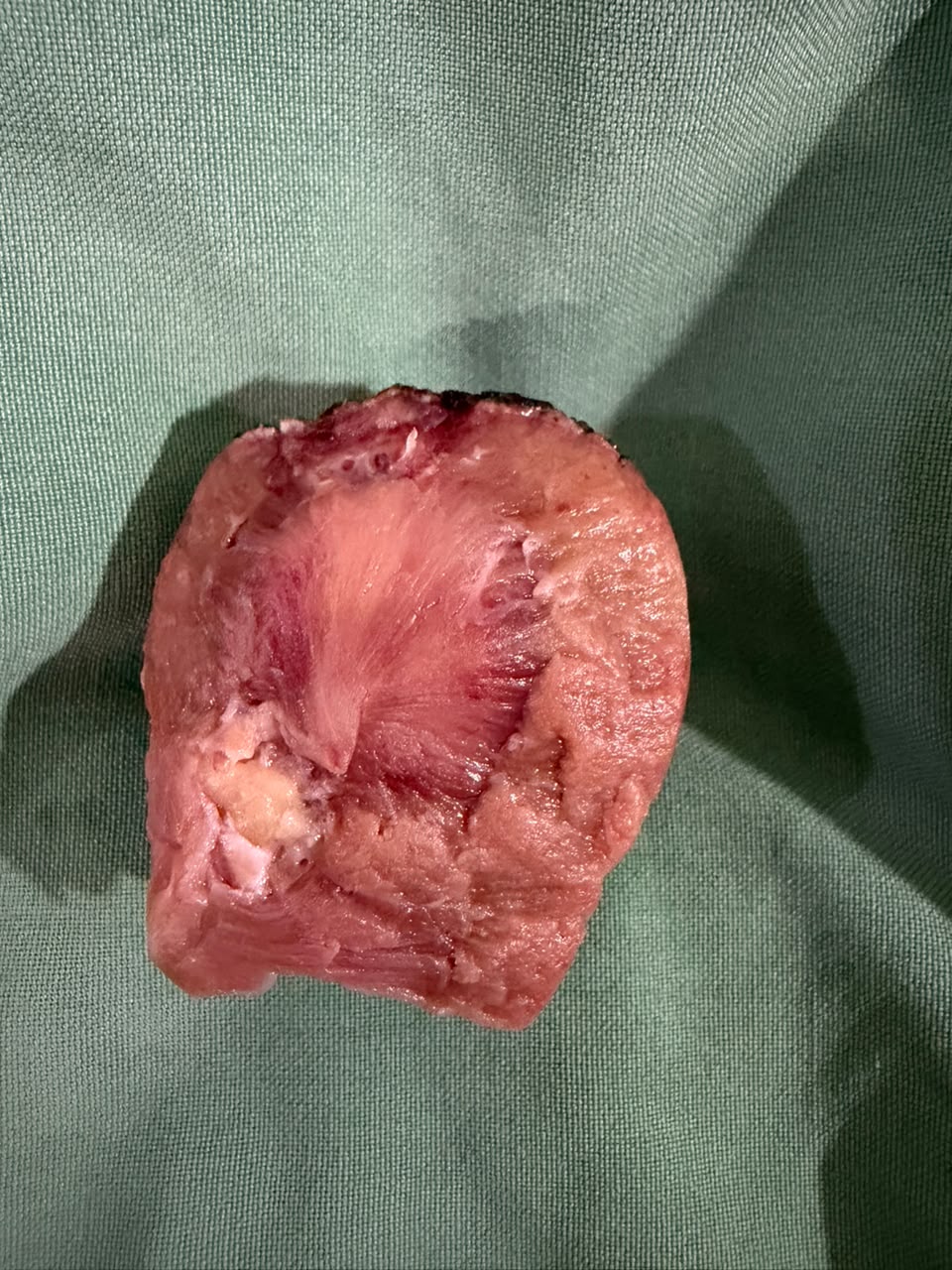 Specimen of robotic partial nephrectomy for kidney cancer 2