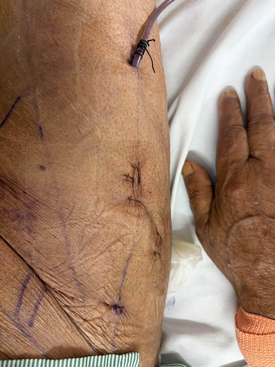 Robotic VEIL for Cancer penis