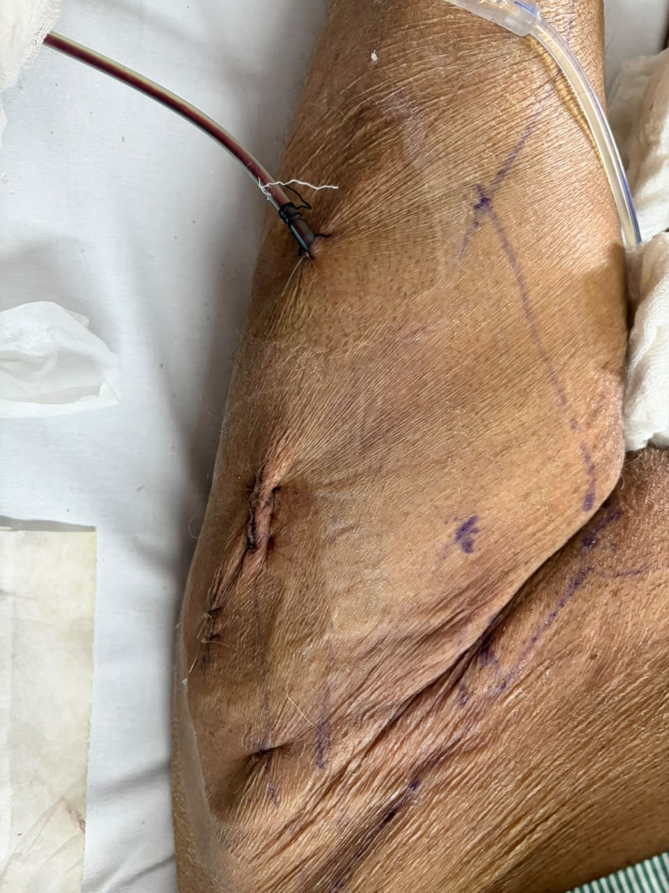 Robotic VEIL for Cancer penis 2