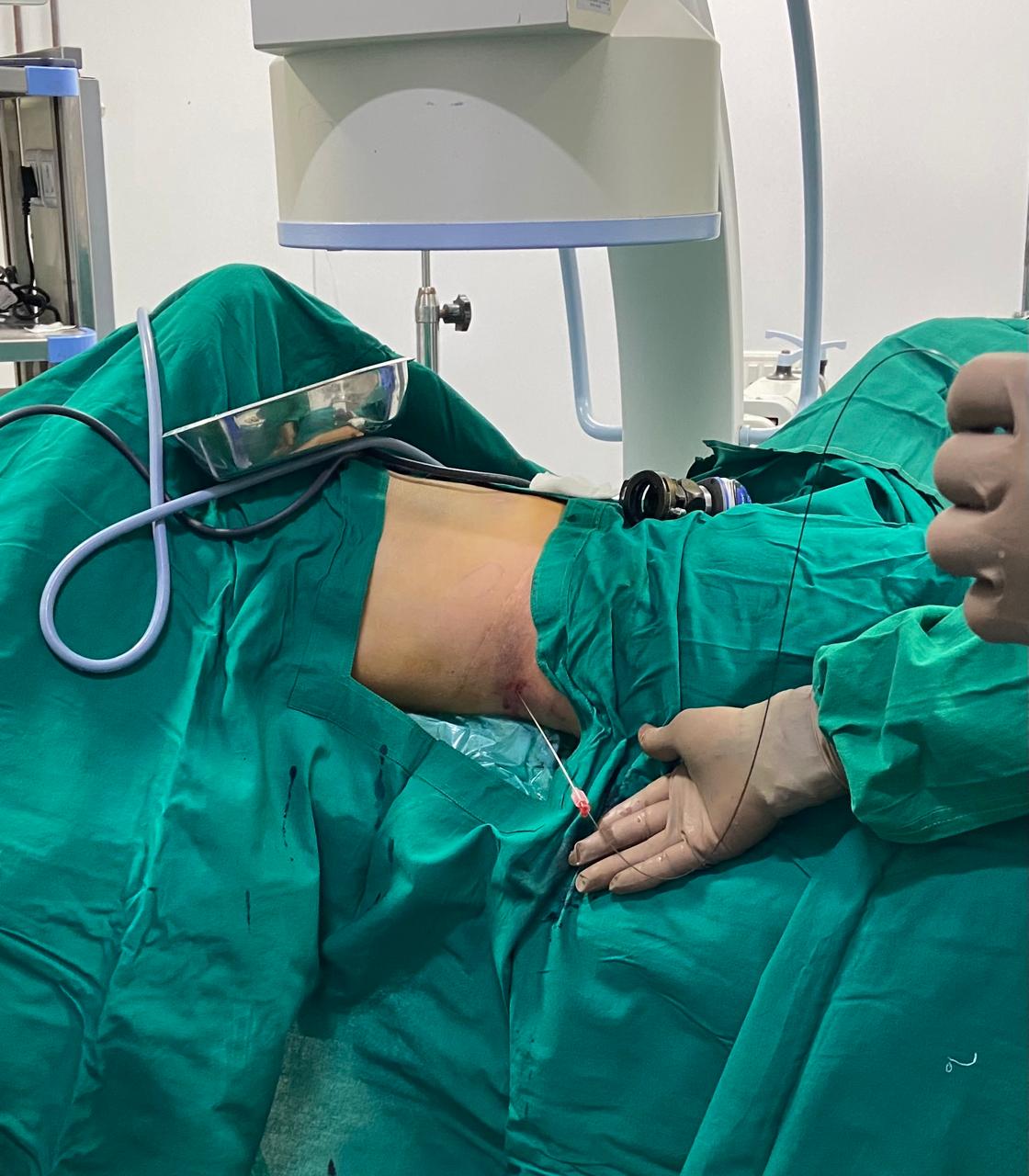 Supine mini pcnl for kidney stones
